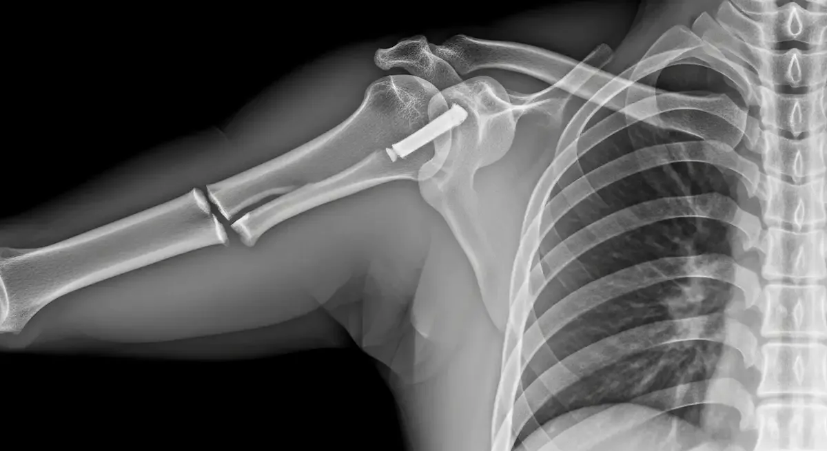 Fratura no ombro precisa de cirurgia