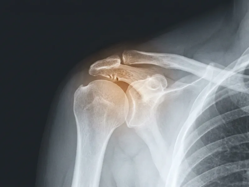 Raio-x ilustrado da articulação acromioclavicular com o espaço articular estreitado