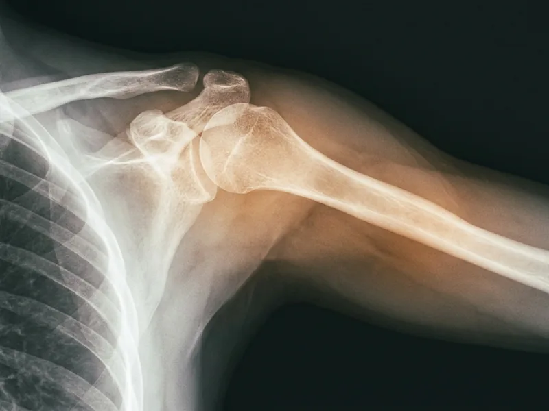 Raio-x ilustrado do ombro e do úmero com a lateral do braço destacada
