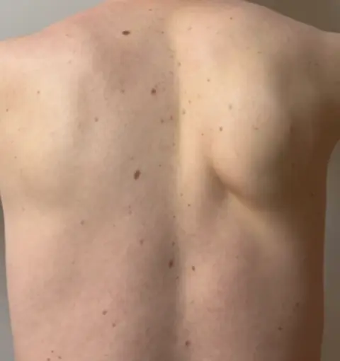 Tratamento para escápula alada em Goiânia com Dr. Thiago Caixeta - ortopedista Especialista em Escápula Alada