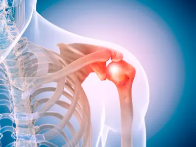Como prevenir dor no ombro esquerdo que irradia para o braço