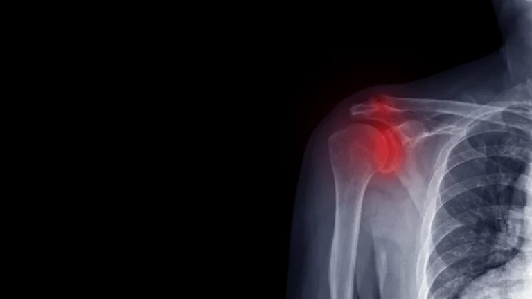 Acromioclavicular