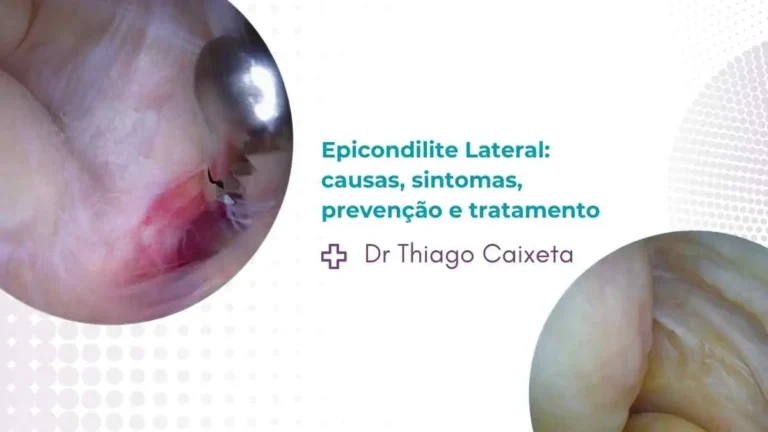 Epicondilite Lateral