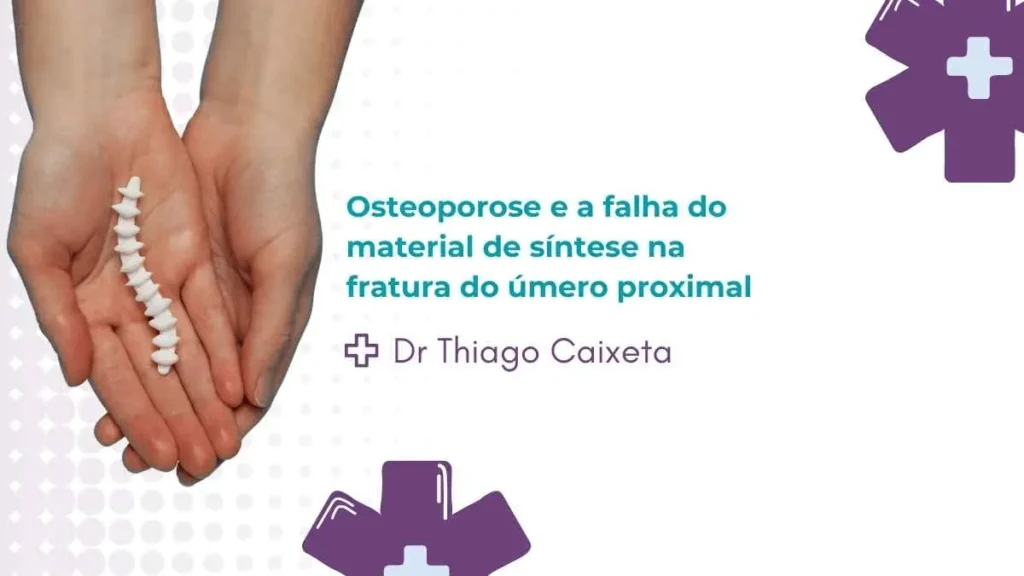Osteoporose e a falha do material de síntese na fratura do úmero proximal