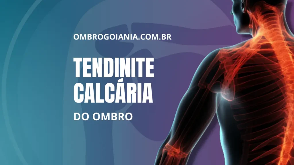 Tendinite Calcária do Ombro