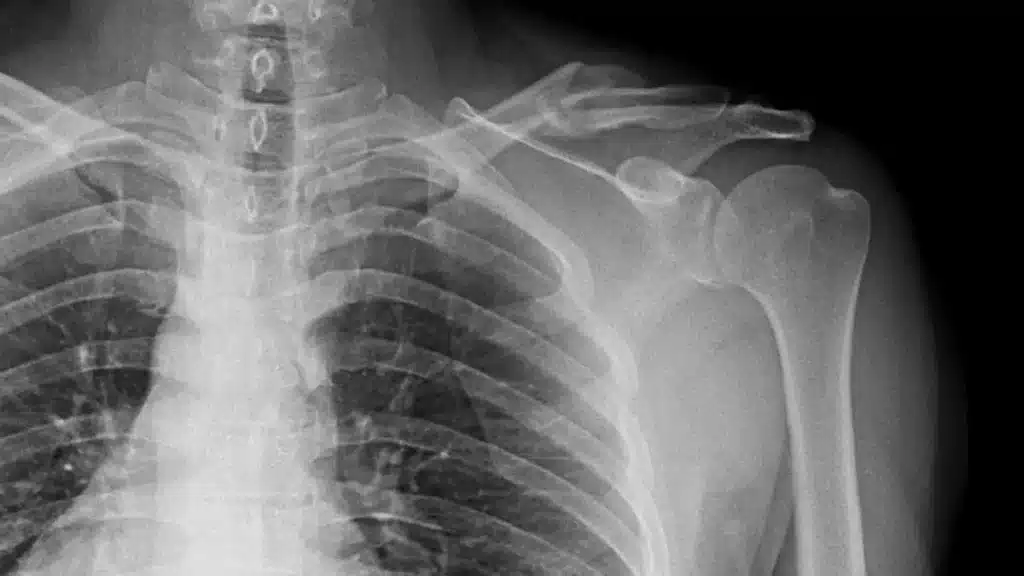 Clavícula quebrada precisa de cirurgia