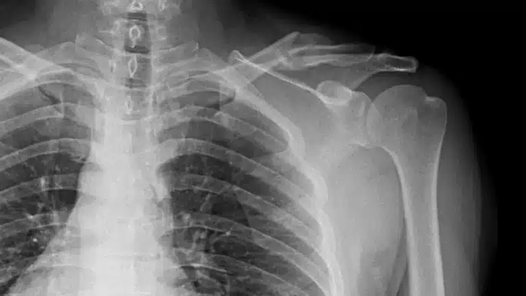 Clavícula quebrada precisa de cirurgia