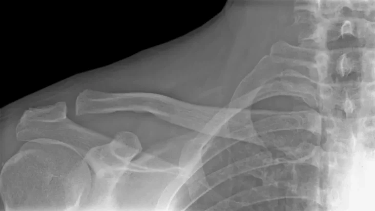 Cirurgia de clavícula com placa