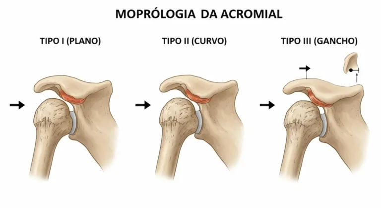 Tipos de acrômio